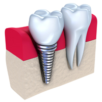 Dental Implant Cross Section
