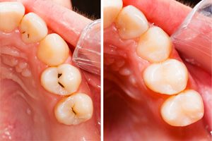 Before and After Composite Fillings