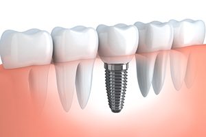 Dental Implants Cross Section