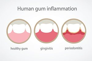 Human Gum Inflammation