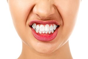 Woman With Bruxism