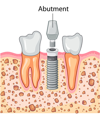 Dental Implant Process - Abutment