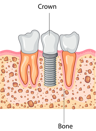 Dental Implant Process - Crown