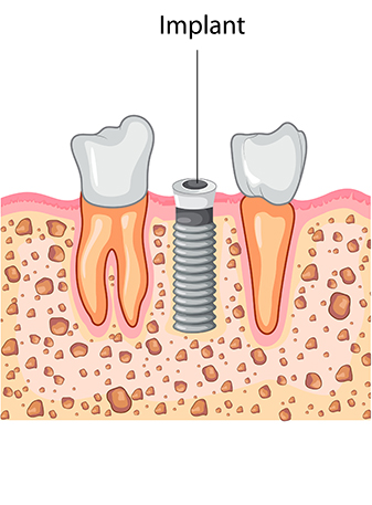 Dental Implant Process - Implant
