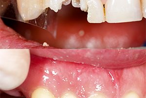 Before and After Dental Bonding