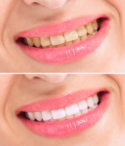 Before and after Teeth Whitening