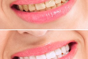 Before and after Teeth Whitening