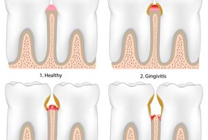 Stages of Periodontal Disease