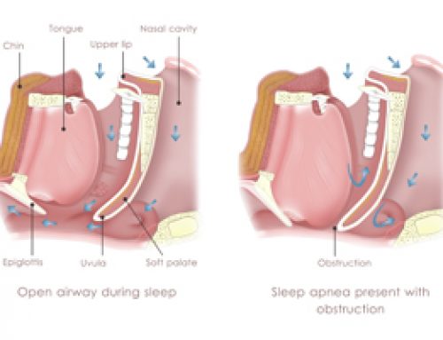 Guard Against Snoring…