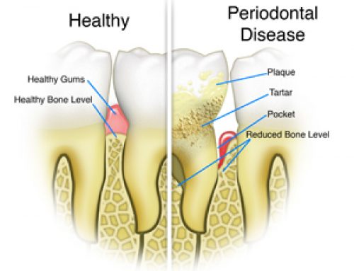 Does Gum Disease Hurt?
