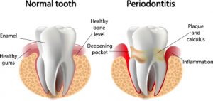 Healthy Tooth VS Periodontitis