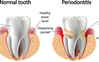 Healthy Tooth VS Periodontitis