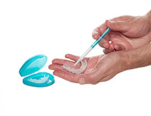 At-Home Teeth Whitening Trays