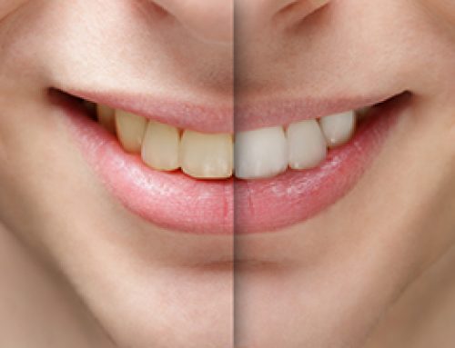 Why Do Teeth Change Color?