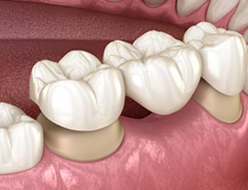 Dental Bridge for Missing Teeth