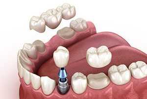 Dental Implants VS Crown & Bridge