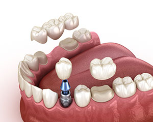 Dental Implants VS Crown & Bridge