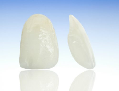 Getting Porcelain Veneers