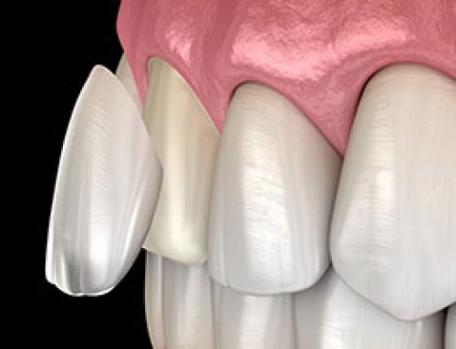 Dental Veneers FAQs