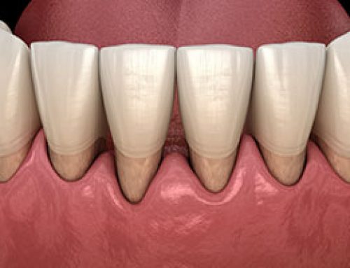 Gum Recession Causes & Effects
