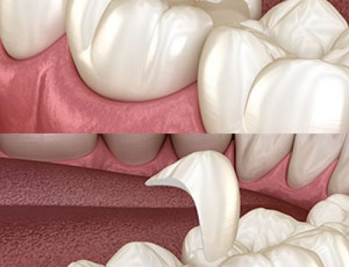 Inlays and Onlays for Your Teeth