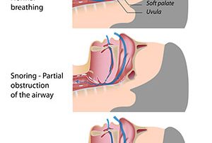 Sleep Apnea Diagram