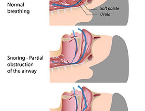 Sleep Apnea Causes & Solutions