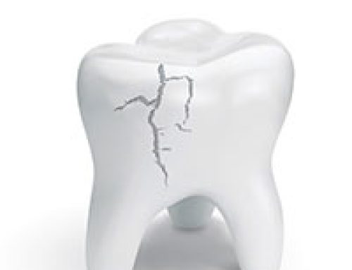 Cracked Tooth Treatment