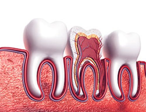 Dead Tooth FAQs