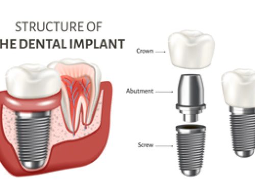 Dental Implants: Their Structure And What’s Involved