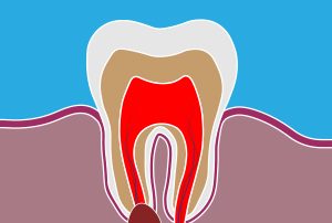 Dental Abscess