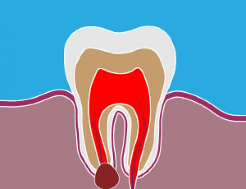 Dental Abscess Treatment