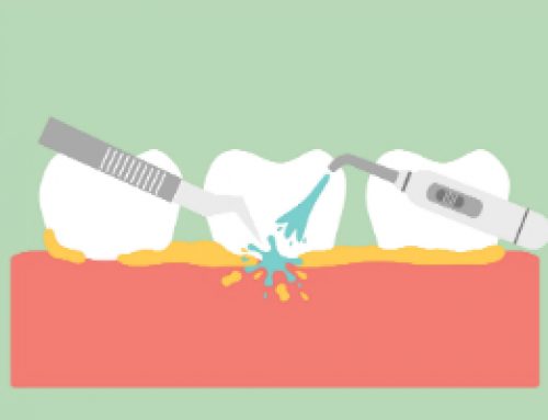 Dental Calculus
