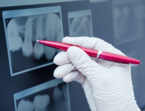 Dental X-Rays: Learn What They Do