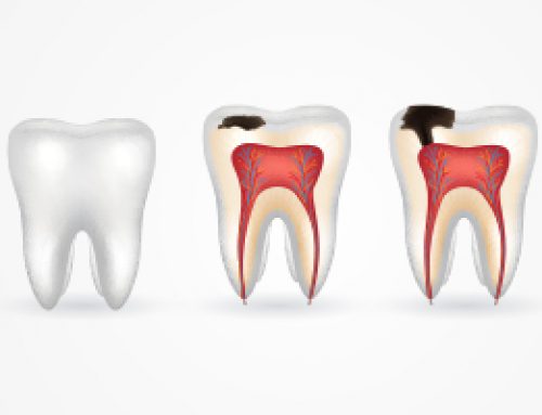 How Do Cavities Start?