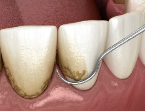 What Is Scaling and Root Planing?