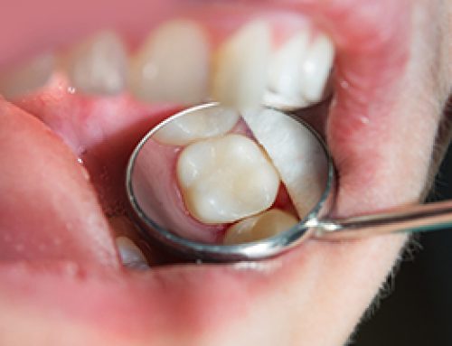 Getting a Cavity Filled