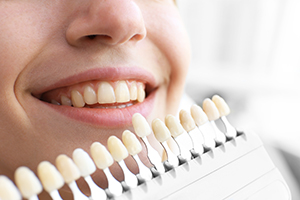 Teeth Whitening Shade Chart