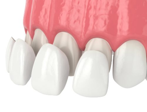 Porcelain Veneers: Get The Perfect Smile!