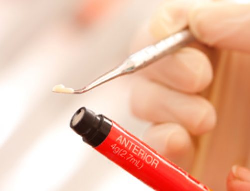 Dental Bonding FAQs