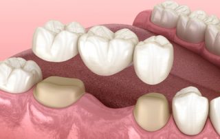 Dental Bridge Illustration