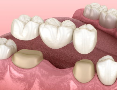 Dental Bridge, What Is It?