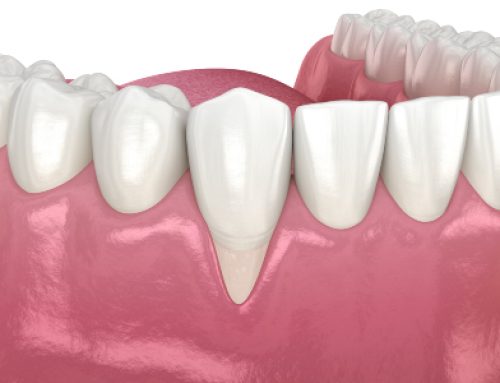 Receding Gums Treatment