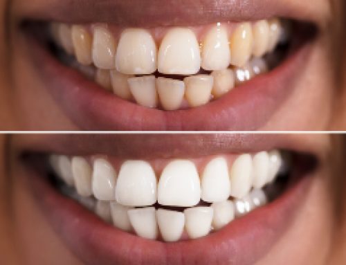 What Can Whitening Do For You?