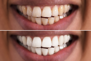 Teeth Whitening Before After
