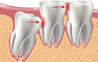 Wisdom Teeth Problems