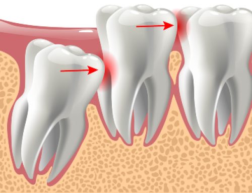 Wisdom Teeth Extractions