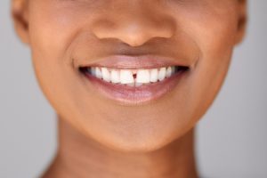 Diastema Gap Teeth