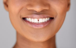 Diastema Gap Teeth