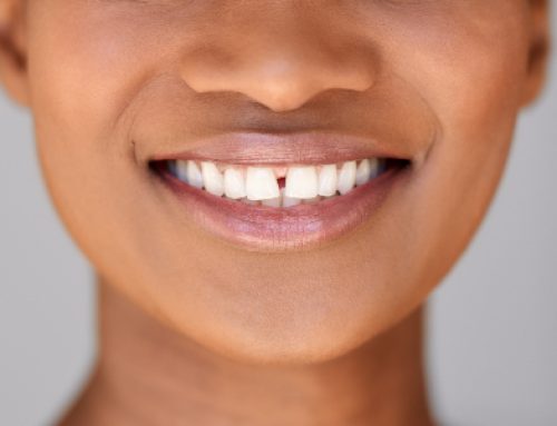 Diastema… Closing The Gap!